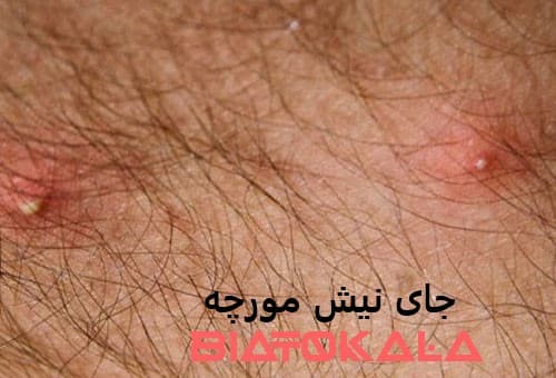 جای نیش مورچه روی پوست و حساسیت پوستی مورچه